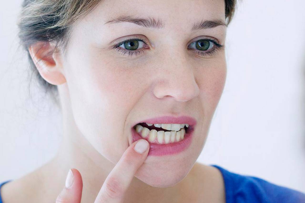 Encías retraídas. Ilustración mostrando una encía sana en comparación con una encía retraída, destacando la exposición de la raíz dental.