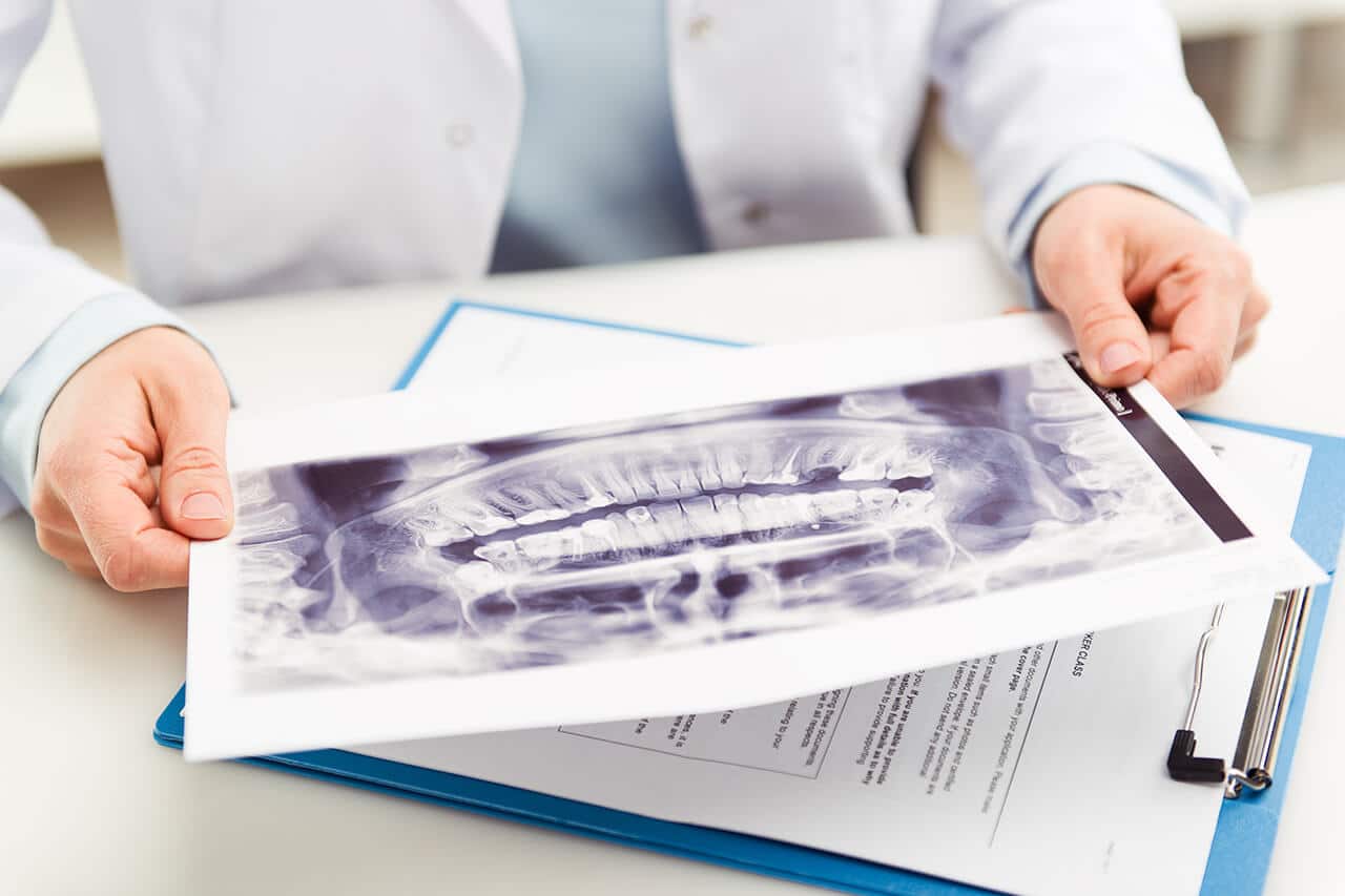 implantes dentales