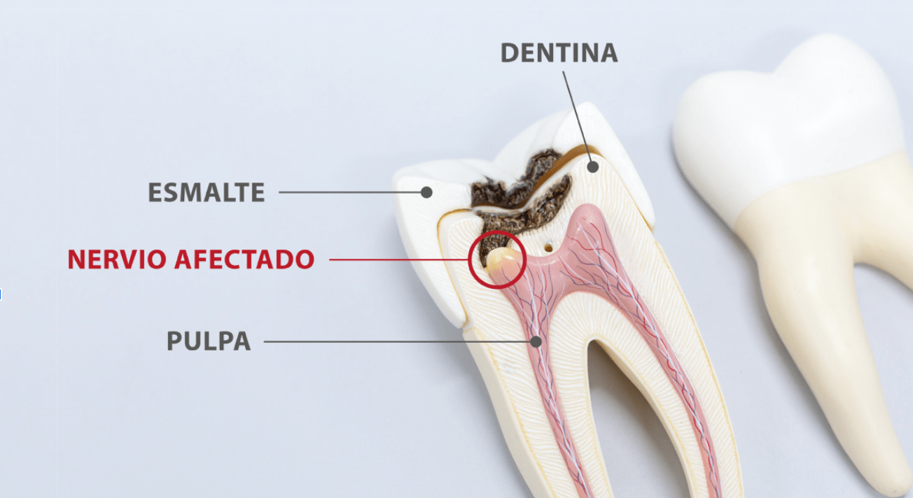 Endodoncia