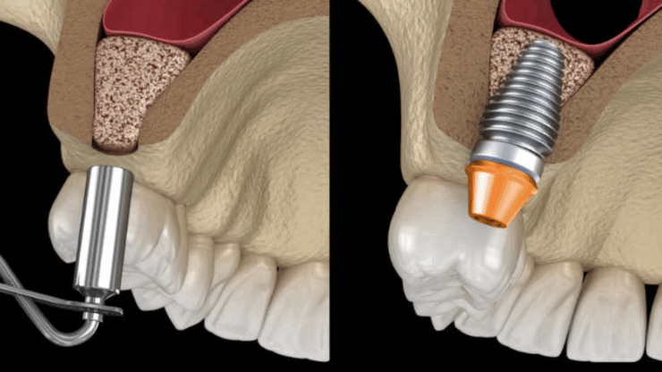 Implantes cortos: una perfecta solución