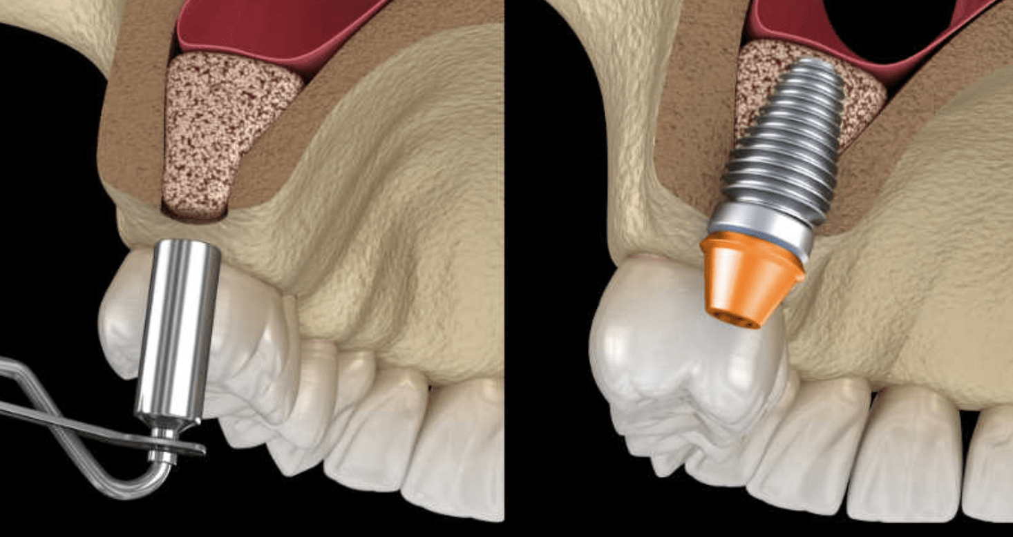 Implantes Cortos
