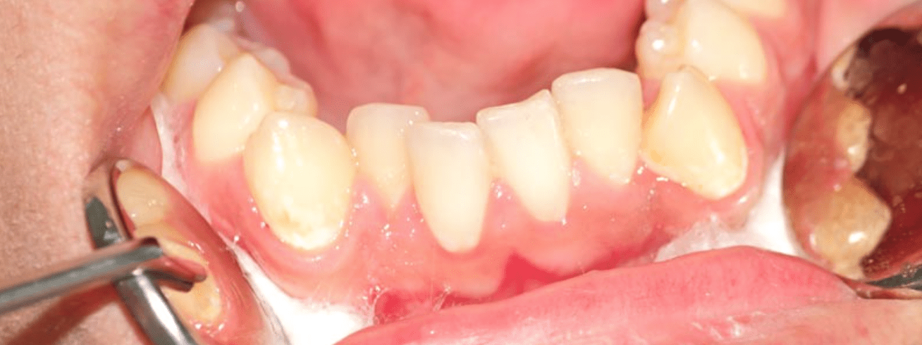 ¿Qué problemas puedo tener debido a los dientes torcidos?