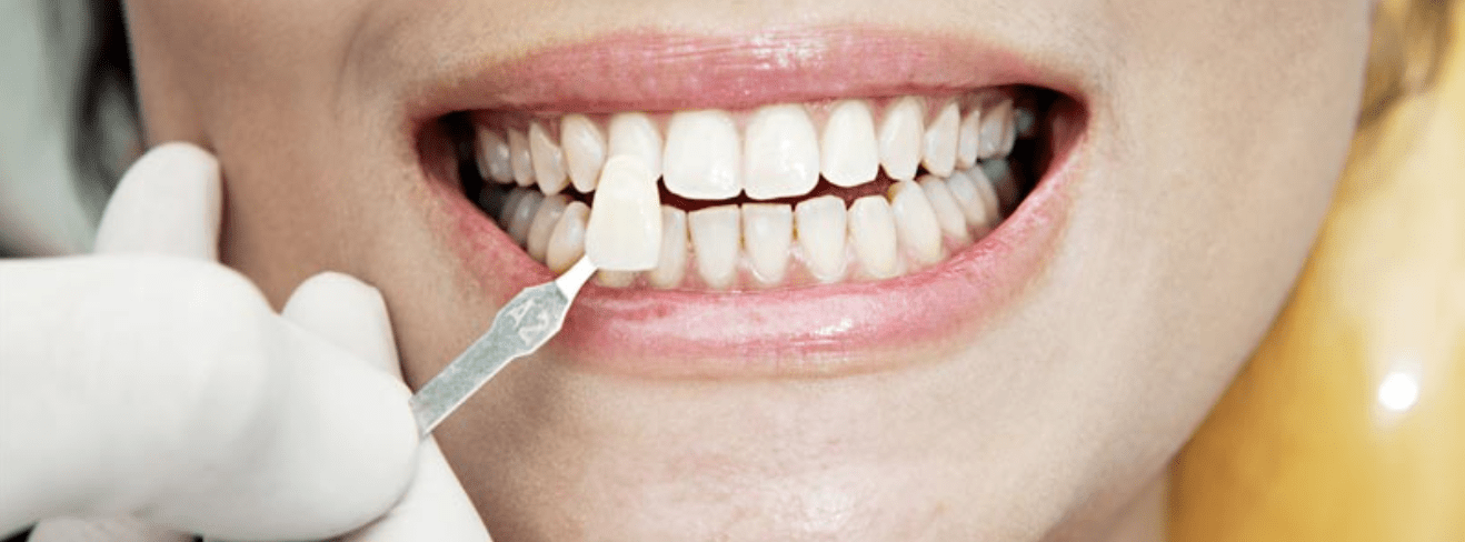 estética dental, carillas, fundas, blanqueamiento
