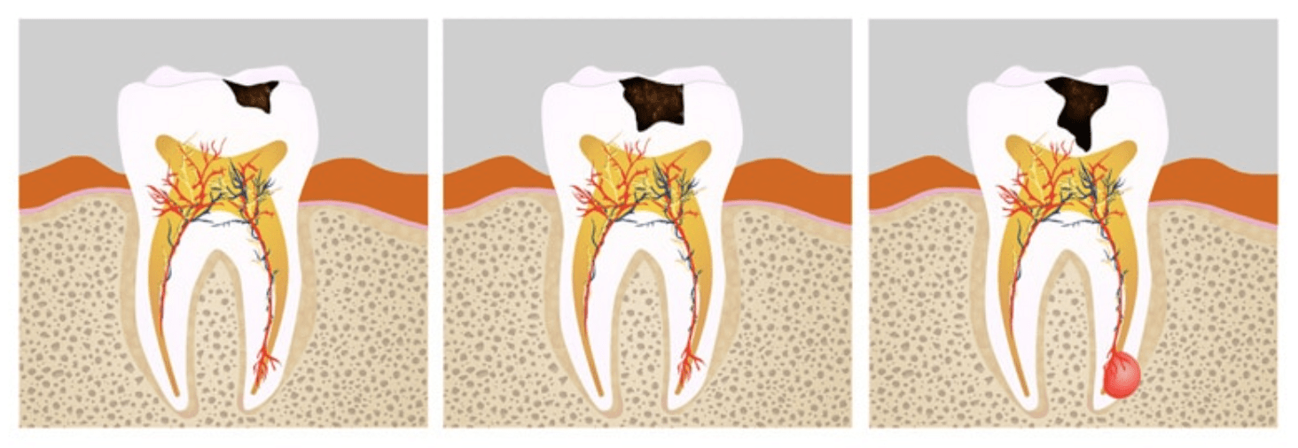 que es una caries dental