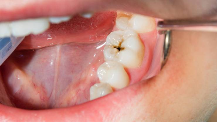 Diez consejos para prevenir las caries