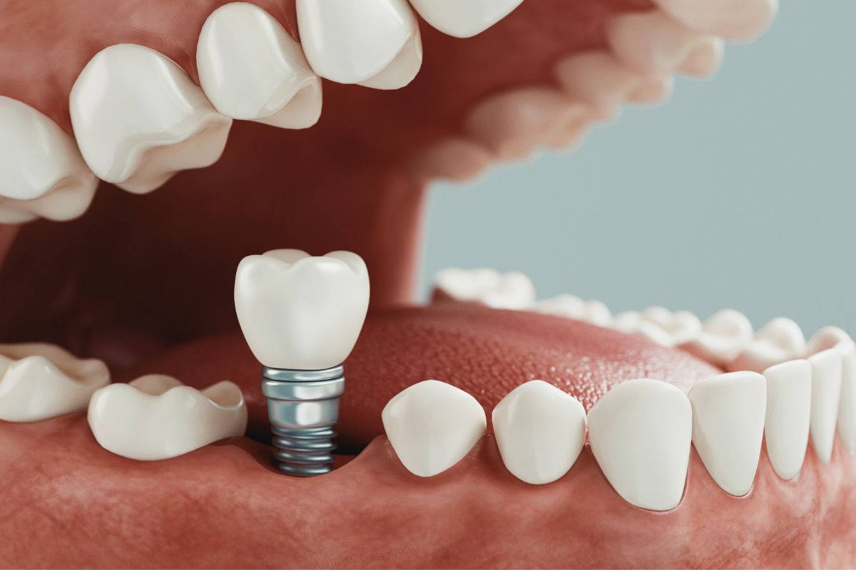 Cirugía con implantes dentales