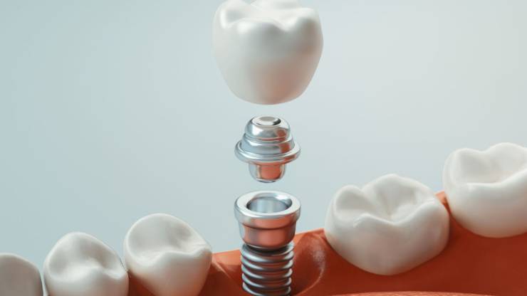 Tratamiento con implantes dentales ¿en qué consiste?