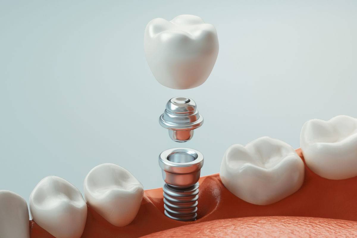 Tratamiento con implantes dentales