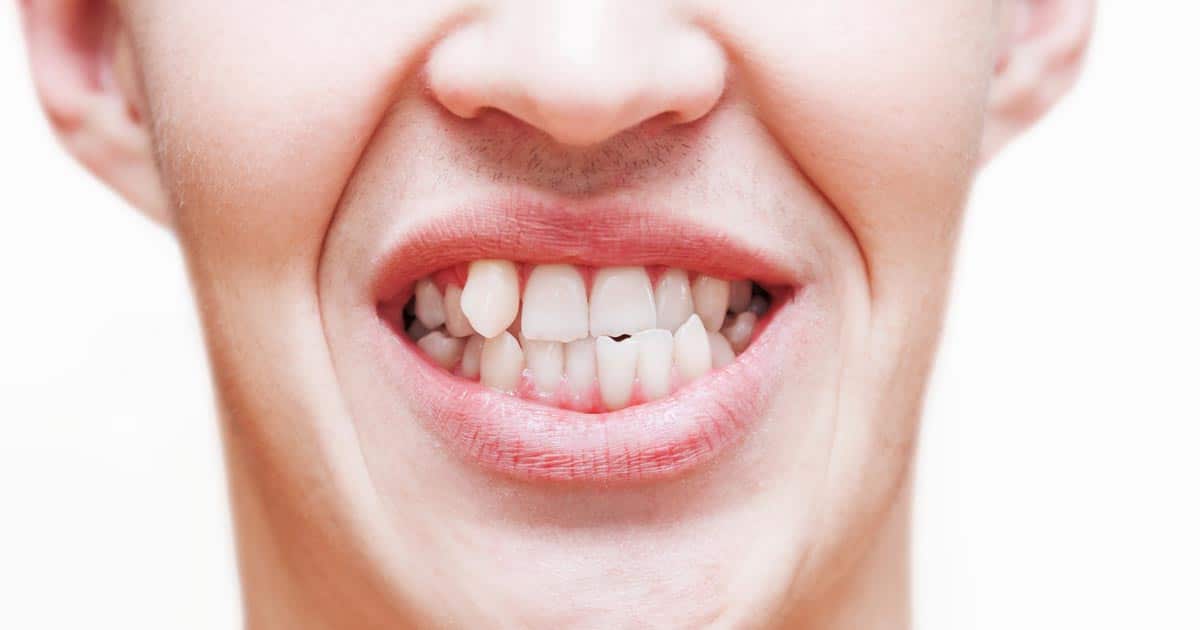 Dientes torcidos