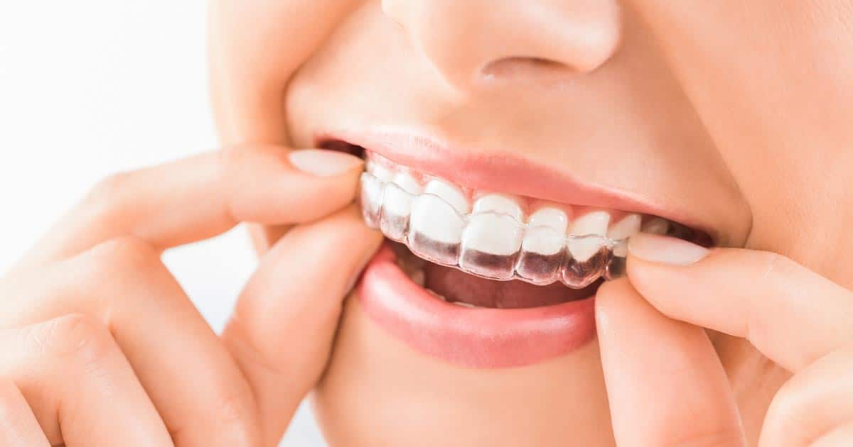 Invisalign