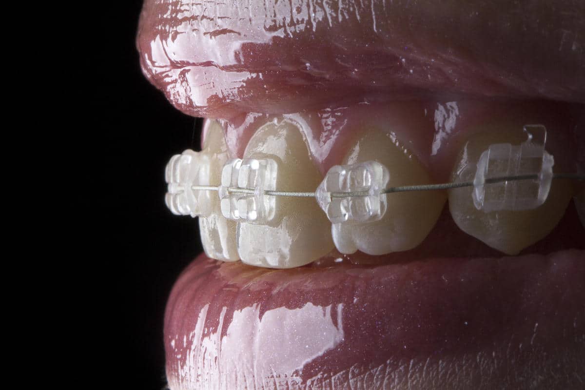 Tipos de ortodoncia disponibles en la Clínica Dental Badanelli para corregir la sonrisa.